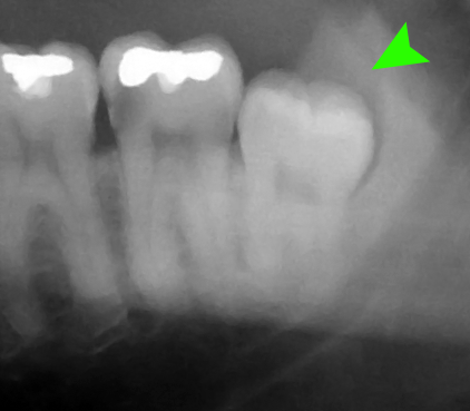 Molar impactado en posición mesioangular